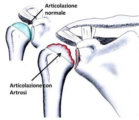 Confronto tra articolazione normale e articolazione con artrosi