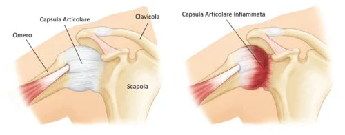 Capsula-articolare-infiammata