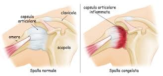 Confronto tra spalla normale e spalla congelata