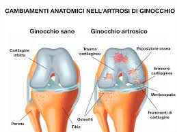 Ginocchio sano e ginocchio con artrosi